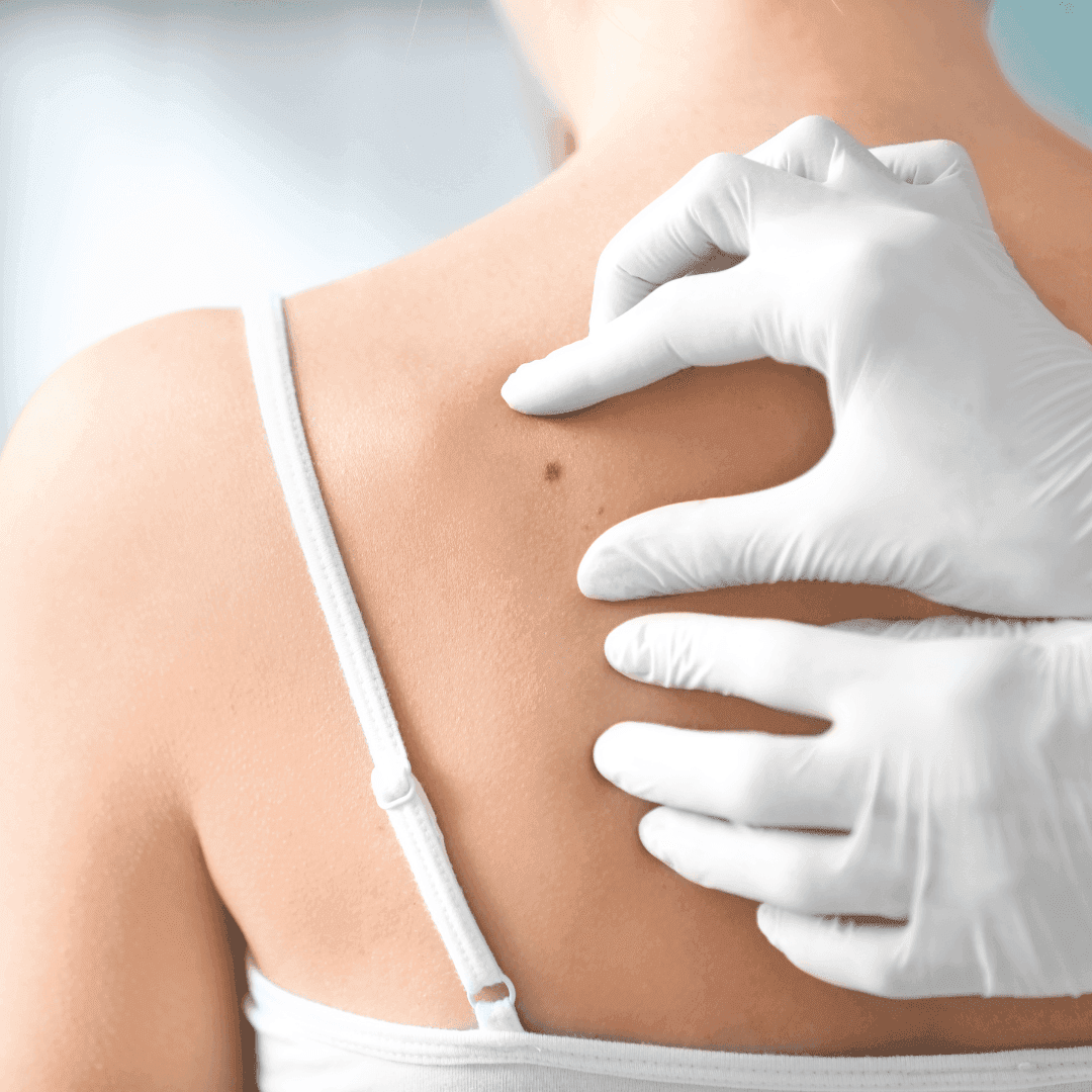 Sette incontri nei Distretti, rivolti alle Cure Primarie, con il Dermatologo Maurizio Lombardo, per conoscere meglio il melanoma e promuovere l'appropriatezza dei percorsi. Stasera, alle 19.00, il primo incontro nella Casa di Comunità di Varese.